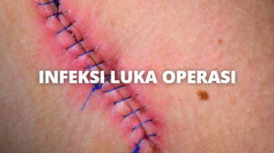 INFEKSI LUKA OPERASI - HarianIndo : Berita Seputar Indonesia Terkini